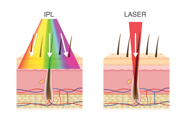 IPL and Laser Services